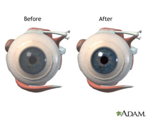 Fuchs’ Corneal Dystrophy