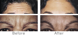 botox
