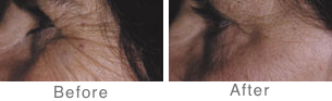 botox