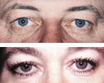 Droopy Eyes