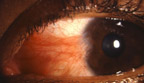 eye