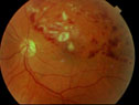 Retinal Vein Occlusion