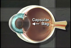 Posterior Capsulotomy