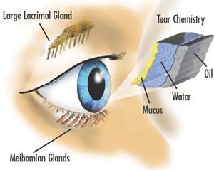 Dry Eye