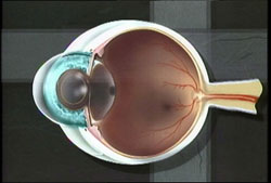 Posterior Capsulotomy