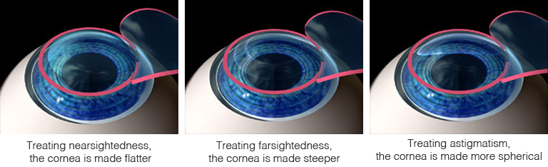 lasik