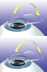 lasik