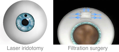 Narrow-Angle Glaucoma