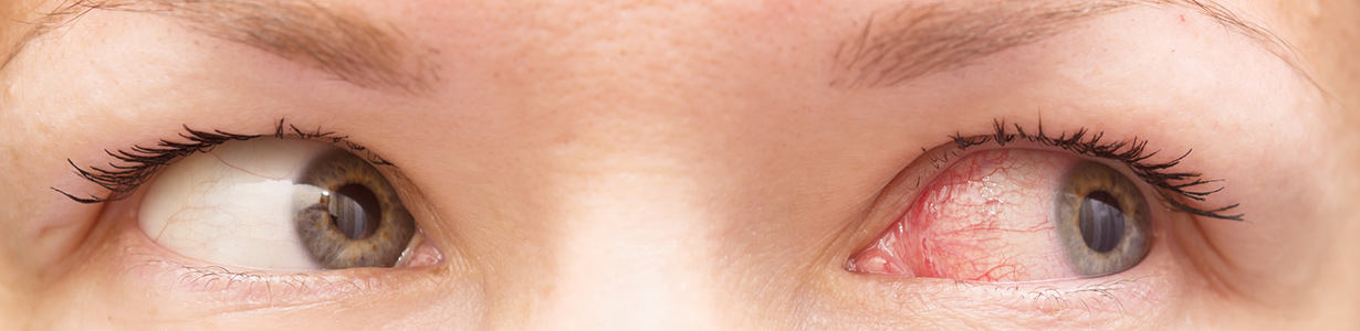 Pink Eye